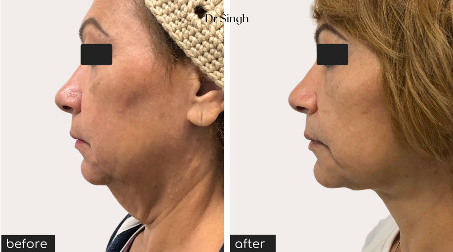 before after mini face lift nyc